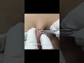 Download Lagu Dr Pimple Popper's Clean Pops That Takes You Back