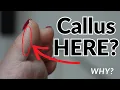 Callus of the Big Toe