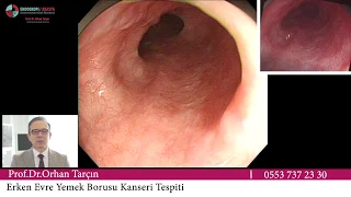 Prof. Dr. Hasan Batırel sorularınızı yanıtlıyor! Bu haftanın konusu Akciğer Kanserinde Ameliyat se. 