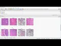 Breast Cancer Classification Using Python