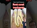 Download Lagu Doctor explains Root Canal treatment #shorts #dental