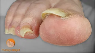 Patient close to 90 years old with osteoarthritis plus visual and motor difficulties | Podology