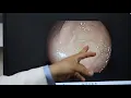 Austin Gastroenterology Introduces AI Technology to Colonoscopies at Austin Endoscopy Centers