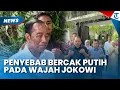 Download Lagu MEMPRIHATINKAN WAJAH JOKOWI Muncul Bercak Putih hingga Memerah, Dokter Tifa Sebut Penyebabnya