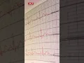 ICU Sound || ECG🫀 #icu #icugyan #sound #ekg