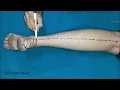 Sural flap - Planning