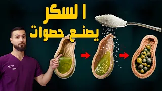 المجرم الحقيقي وراء حصوات المرارة (ليس الكوليسترول) لماذا تفشل حميتك في منع الحصوات؟