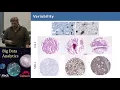7 5 Thomas Fuchs Lecture 5 Random Forests in Cancer Research
