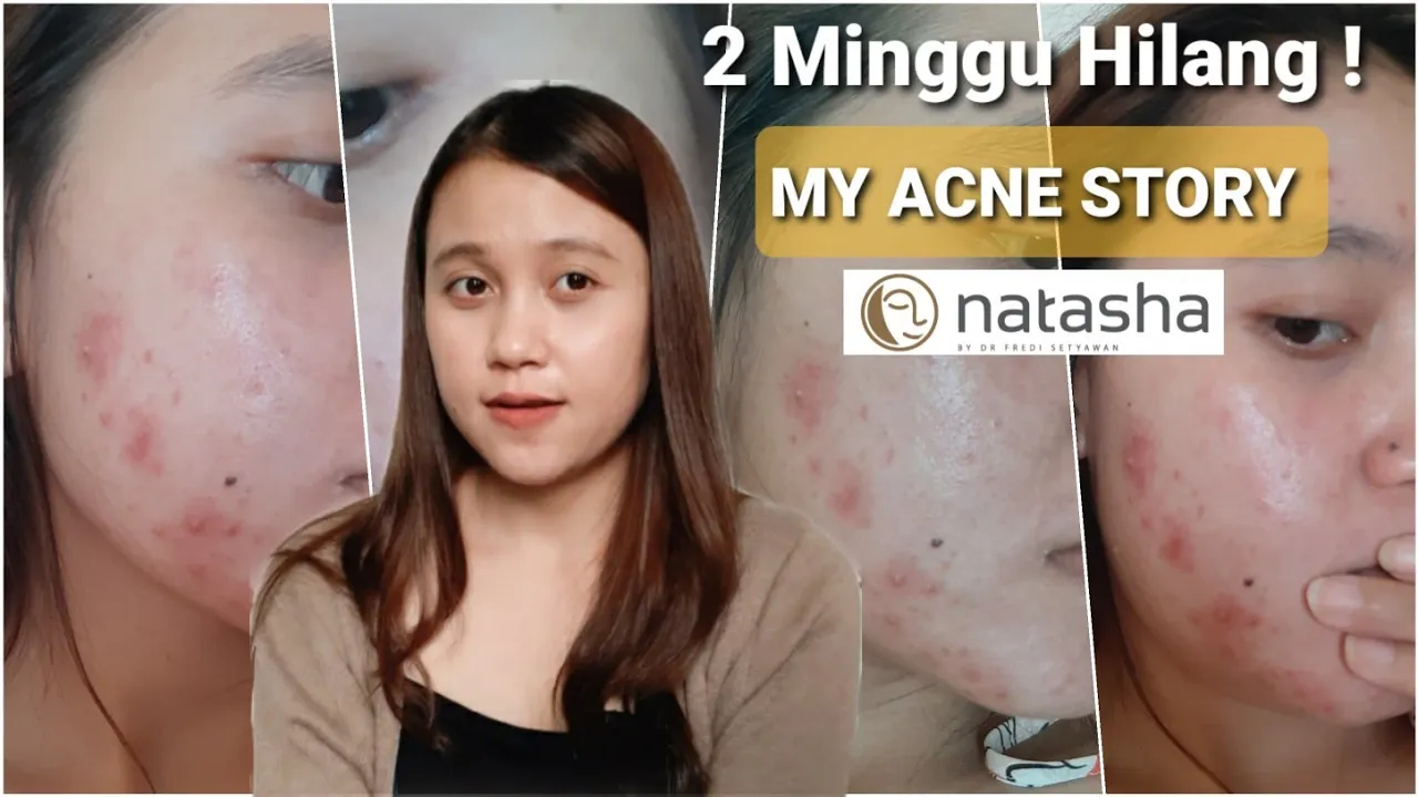 Tips WAJIB sebelum Laser Jerawat Batu Kutil Milia! | Natasha Skincare Sidoarjo. 