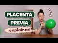 Placenta Previa Explained Diagnosis Bleeding Risks Delivery Plan and Safe Exercise