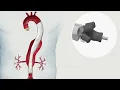 Download Lagu E-nside TAAA Multibranch Stent Graft System Product Animation