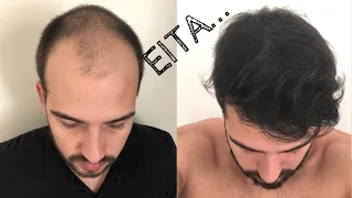 15 anos mais Jovem após o TRANSPLANTE CAPILAR