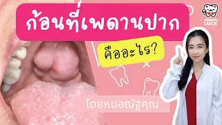  ก้อนที่เพดานปากที่ไม่เจ็บและไม่โตขึ้น อาจเป็นอะไรได้บ้าง 