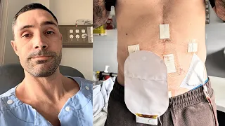 Reece had his colon removed. Here's what happened 😬