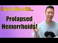 How to live with prolapsed hemorrhoids It is possible