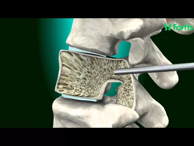 Vertebroplasty & Kyphoplasty ( Spine Surgery) Neuro Surgery; Fortis Healthcare,India