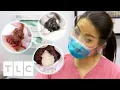 8 Satisfying Minutes Of Popping Cysts Lipomas And Blackheads Dr Pimple Popper