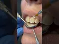 Watch How a Dentist Enhances Front Tooth Shape Using Modern Composite Restoration Techniques