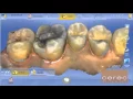 CEREC - One Visit Crowns