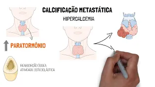 Calcificações patológicas - Distróficas e Metastáticas