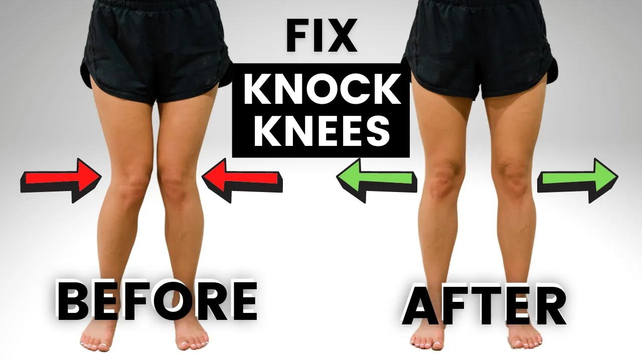 How to Fix KNOCK KNEES (without SURGERY!)