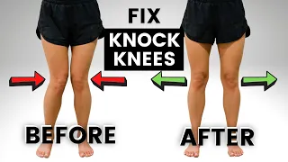 how to fix knock knees without surgery 