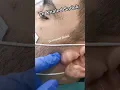 Download Lagu Ear we go again #skincare #pimplepopping #blackheadremoval dr Khaled Sadek