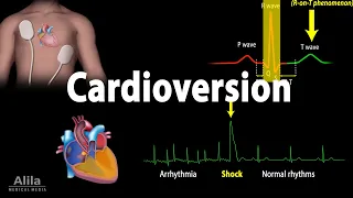 cardioversion electrical procedure animation