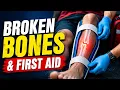 Broken Bones First Aid What to Do What NOT to Do First Aid Guide