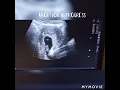 abortion in progress ultrasound case