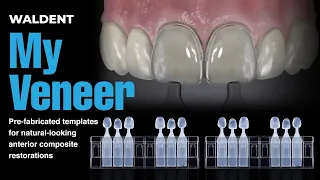 Pre-fabricated templates for natural-looking anterior composite restorations Waldent My Veneer