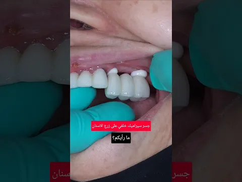 جسر سيراميك خلفي على زرع الاسنان