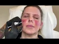 Download Lagu Botox for Treatment Rosacea