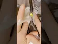 Draining Abscesses