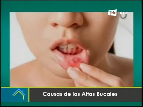 Causas de las aftas bucales