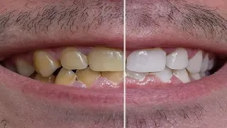 HOW TO GET WHITE TEETH THIS IS INSANE