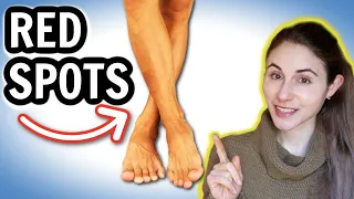 Why you get RED SPOTS ON THE LEGS HOW TO GET RID OF THEM Dermatologist DrDrayzday