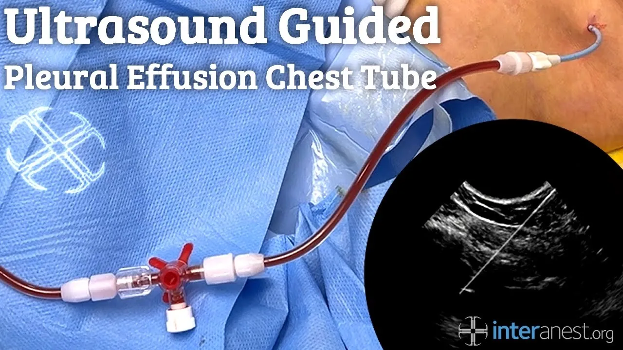 Ultrasound guided Pleural Effusion Chest Tube