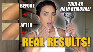 At Home Laser Hair Removal That Actually Works | TRIA 4X Honest Results | NINA UBHI