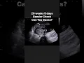 Download Lagu 20 weeks 5 days Gender Check #jerbearimaging #genderreveal #girlorboy #boyorgirl #fyp