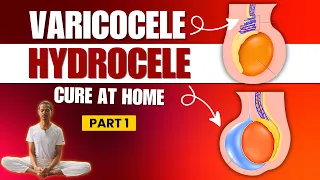 Yoga to Heal Varicocele & Hydrocele at Home Part 1 #varicocele #hydrocele