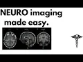 Neuroanatomy on MRI Part 1 Cerebrum Basal Ganglia Thalamus Internal Capsule Lesions