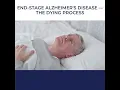 Download Lagu Uncovering the Reality of End-Stage Alzheimer's: How the Dying Process Unfolds 😶‍🌫