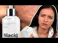 My 10 month results of using Niacid by slurp on my pitted acne scars Honest Review