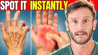 I Can Spot Insulin Resistance Just by Looking at Your Hands
