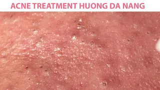 Acne Treatment Huong Da Nang#253#blackhead#short#