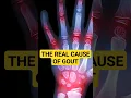 Download Lagu Here's Why You Have GOUT, And How To Fix It!   #gout