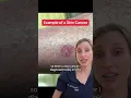 Sharing examples of skin cancer so you can have an informed idea of what to look for in self exams
