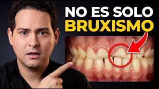 Lo que nadie te dice de los dientes DESGASTADOS