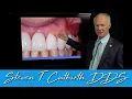 Abfraction on Tooth Colored Restorations - Dental Minute with Steven T Cutbirth DDS